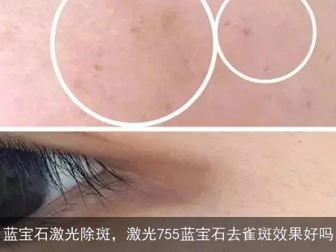 蓝宝石激光除斑，激光755蓝宝石去雀斑效果好吗